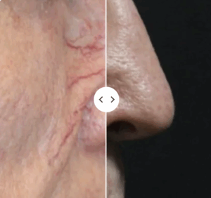 vein removal before and after vascupen